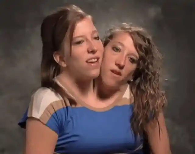 Conjoined Twins Finally Bare All To Show Us How They Really Look Like Below...