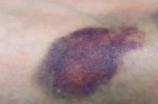 A Father Set Up Camera In Daughter's Room To Find Out Why She Wakes Up With Bruises Every Morning
