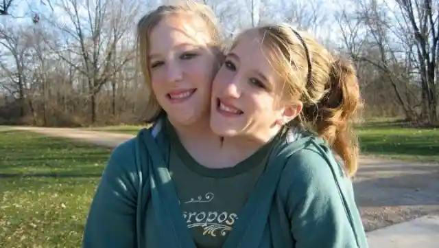 Conjoined Twins Finally Bare All And Reveal What They Truly Look Like After Separation