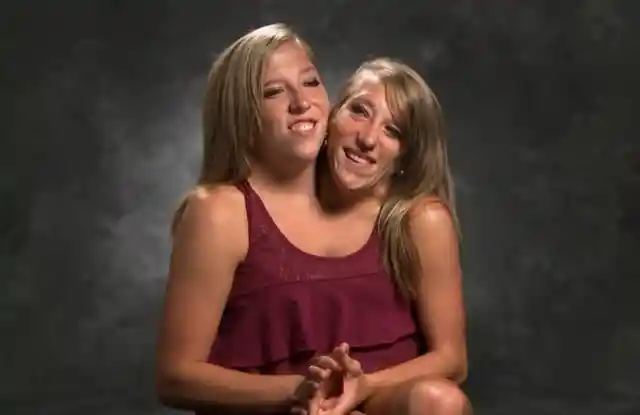 Conjoined Twins Finally Bare All And Reveal What They Truly Look Like After Separation