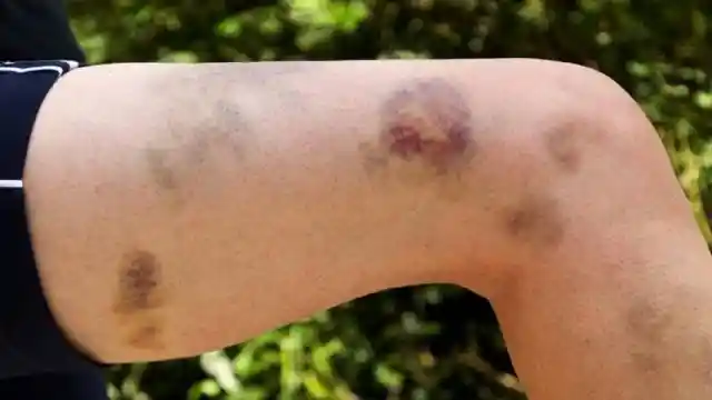 Parents Install Camera In Daughter’s Room To Find Out Why She Wakes Up With Bruises Every Day