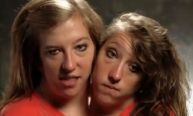 Conjoined Twins Finally Bare All And Reveal What They Truly Look Like After Separation