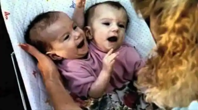 Conjoined Twins Finally Bare All And Reveal What They Truly Look Like After Separation