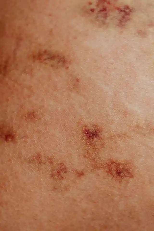 Skin Rashes