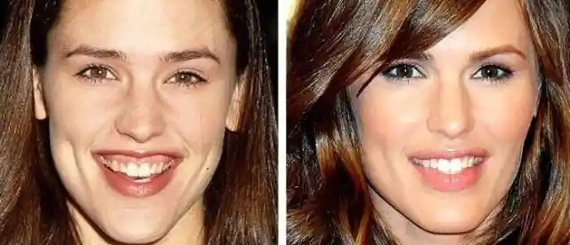 Shocking Before And After Celeb Teeth Transformation Photos