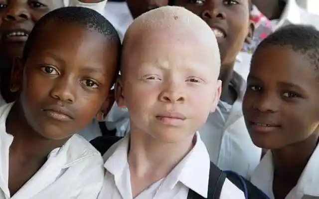 Albinism?