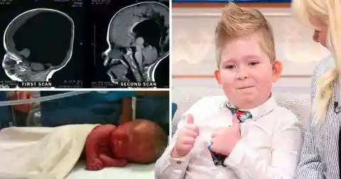 Boy With 'No Brain' Defies Neuroscience After He Miraculously Grew His Brain to 80%