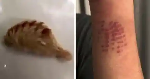 Teenager Has ‘Burning’ Grid-Like Mark On Arm And Mom The Horrific Truth