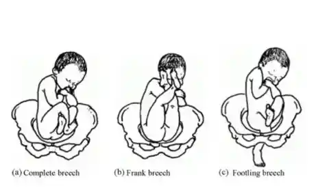 Different types of breech positions