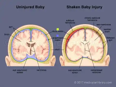 Shaken Baby Injury