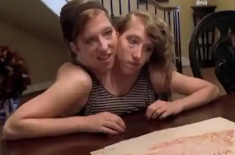 Years After These Siamese Twins Were Born, They Shared Shocking News