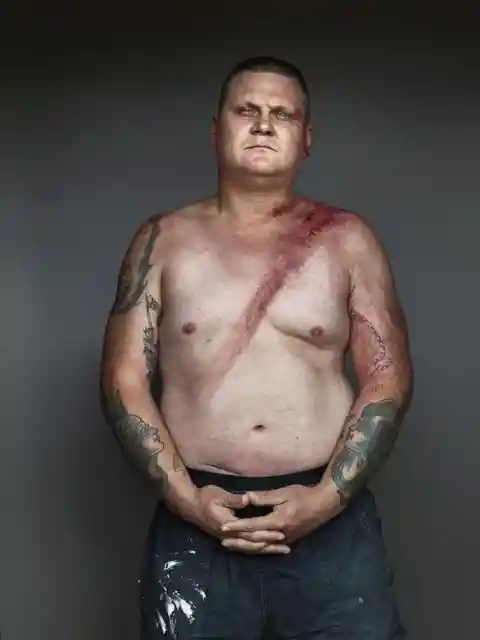 Compelling Portraits of Car Accident Survivors Show the Lifesaving Effects of Seatbelts