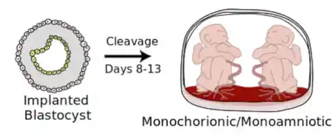 Twins Together In The Same Amniotic Sac