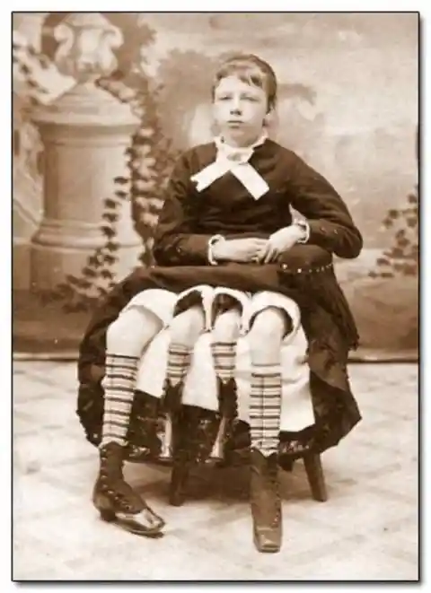 Myrtle Corbin, who was born in 1868 with an extra pelvis. Myrtle spent her early years in a circus