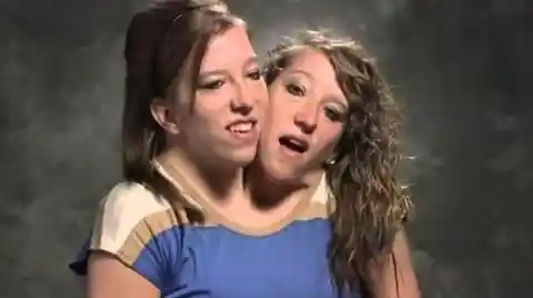 Conjoined Twins Finally Bare All And Reveal What They Truly Look Like After Separation