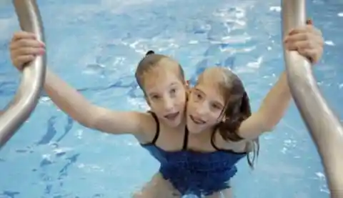 Conjoined Twins Finally Bare All And Reveal What They Truly Look Like After Separation