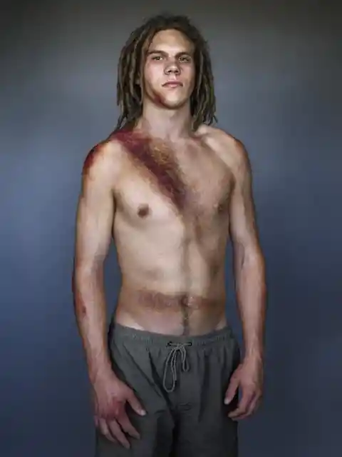 Compelling Portraits of Car Accident Survivors Show the Lifesaving Effects of Seatbelts
